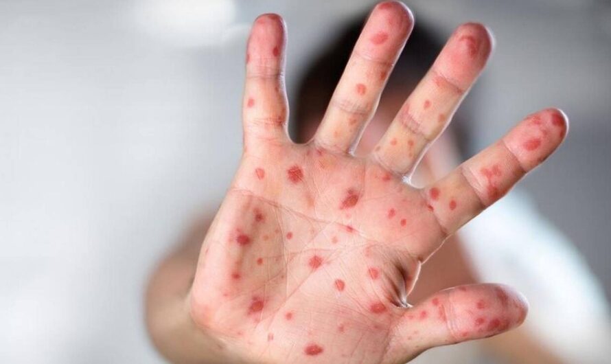 俄勒冈州报道第二例猴痘，或更多！